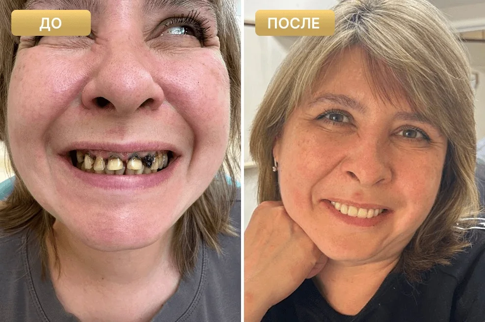 Результат лечения: фотографии до и после